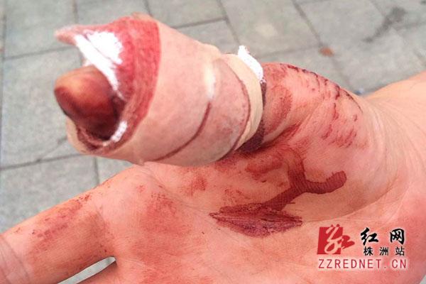 男子饭店观光水池里撩水 被娃娃鱼咬伤 男子饭店观光水池里撩水 被娃娃鱼咬伤