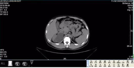 男子腰酸背痛一查竟有4个肾 发病率约十万分一(图) 男子腰酸背痛一查竟有4个肾 发病率约十万分一
