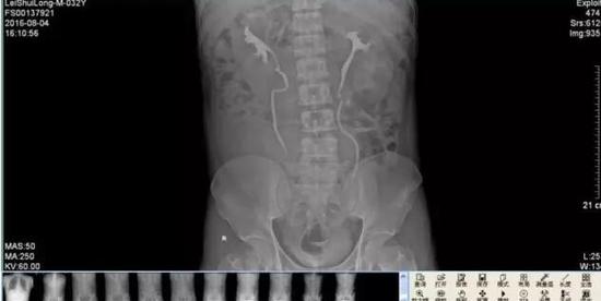 男子腰酸背痛一查竟有4个肾 发病率约十万分一(图) 男子腰酸背痛一查竟有4个肾 发病率约十万分一