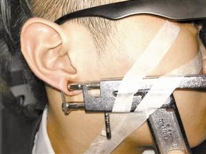 年轻男子赶时髦打耳洞 却被耳钉枪咬住不放 耳钉枪失灵夹住年轻男子的耳朵。